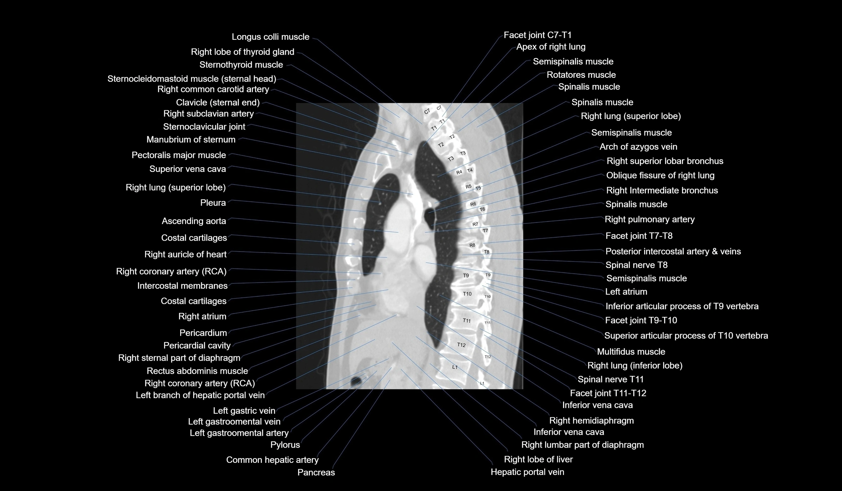 CT chest (thorax) labelled sagittal cross sectional anatomy radiology image-00068.webp
